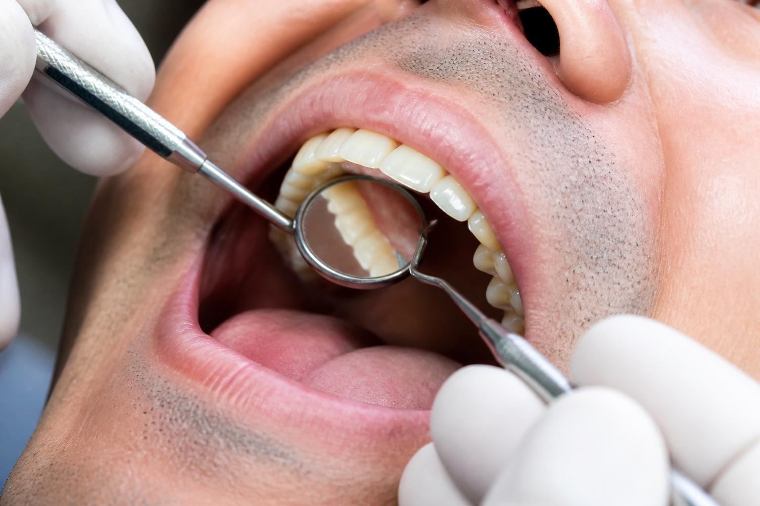 Close-up of a dental check-up examination with mirror and probe
