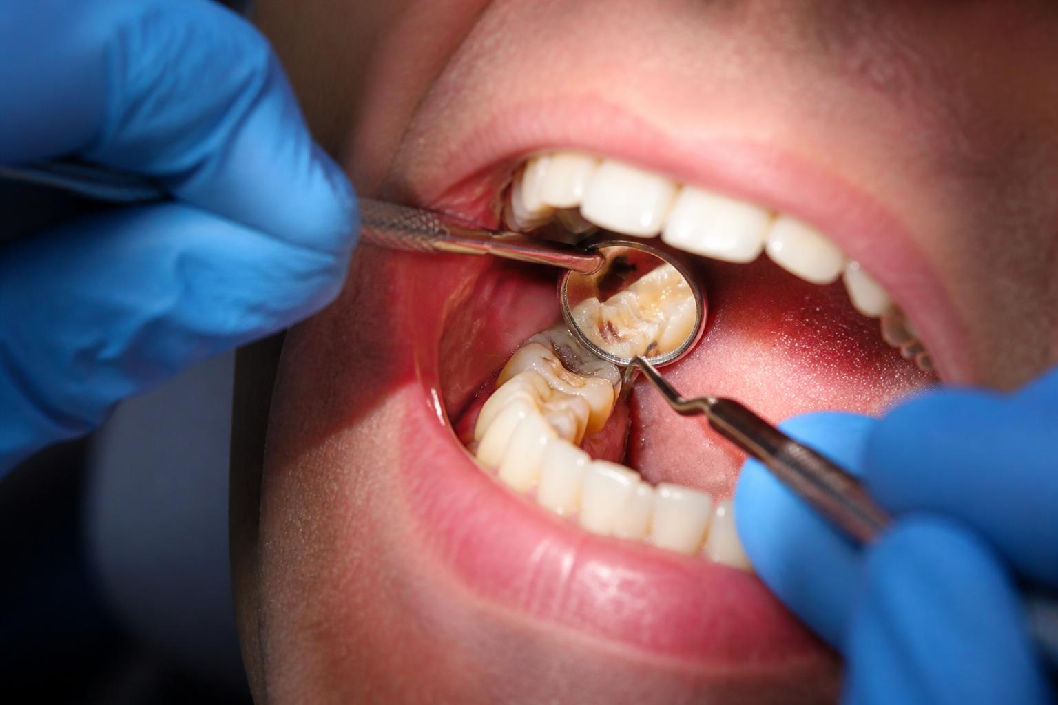 Emergency dental examination of a painful molar
