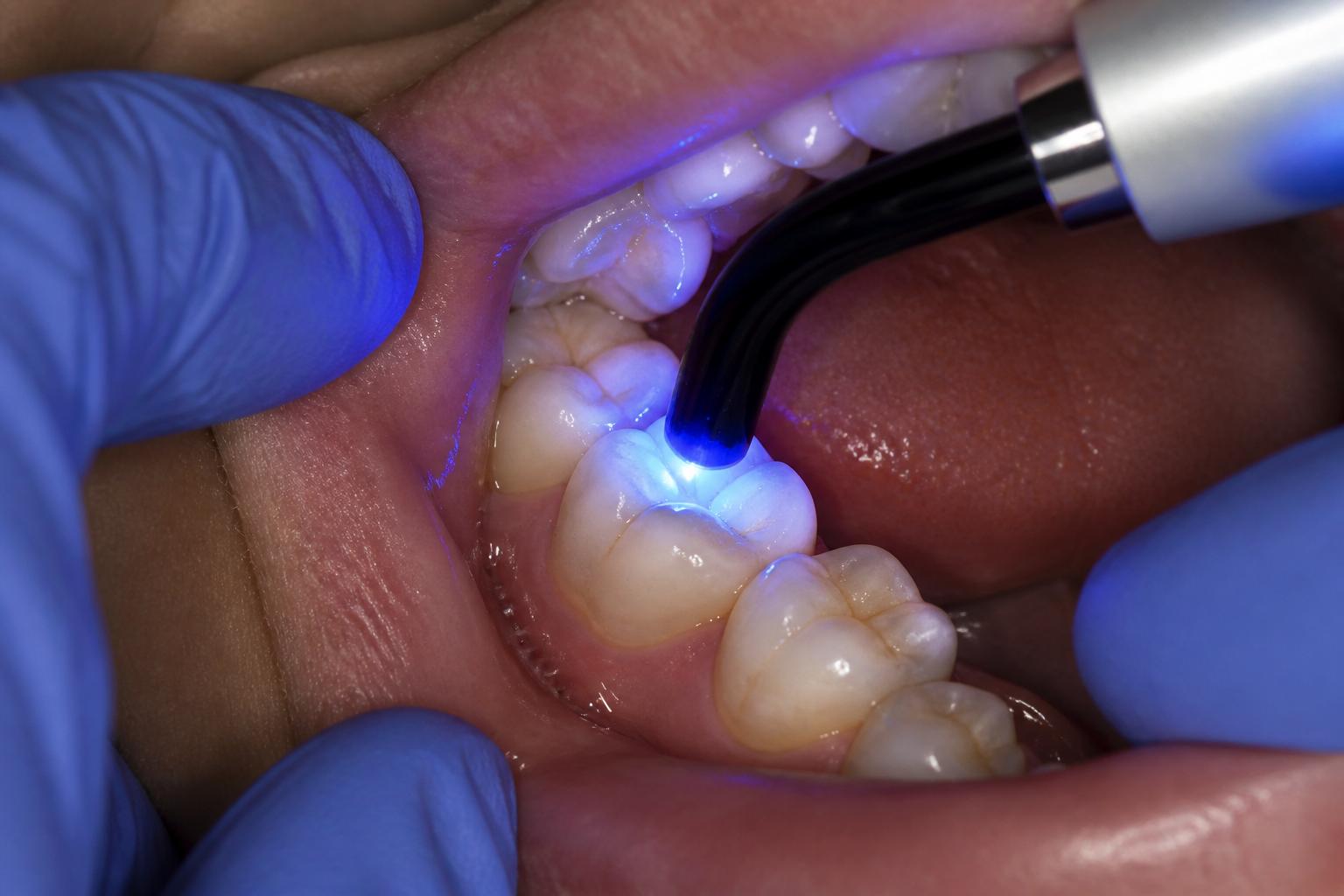 Curing light setting a fissure sealant on a back tooth